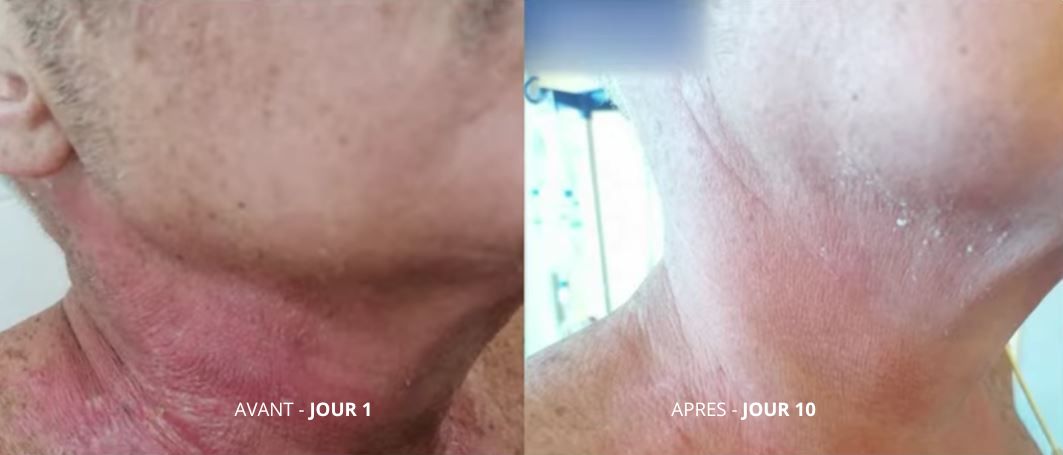 La lumière rouge pour lutter contre les effets secondaires des traitements du cancer